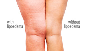 Lipedema treatment