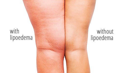 Lipoedema