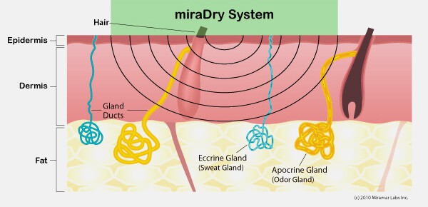Grafische Darstellung der miraDry Behandlung - Teil 1