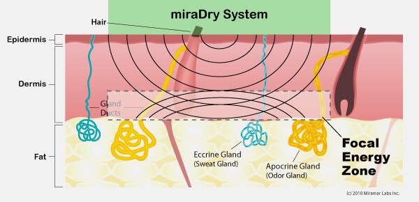 Grafische Darstellung der miraDry Behandlung - Teil 2