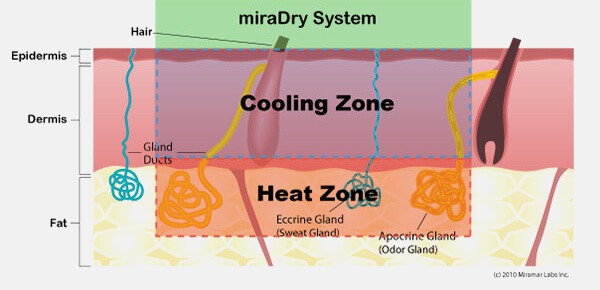 Graphical representation of the miraDry treatment - Part 3