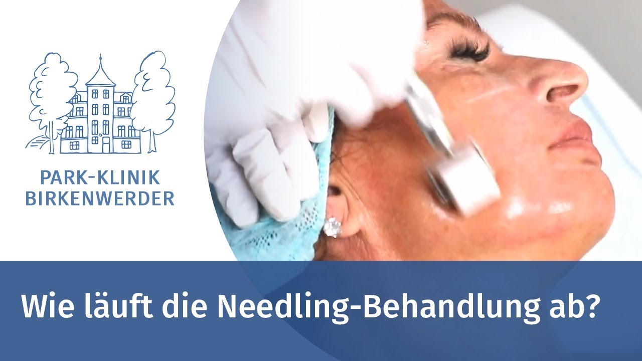 Vorschaubild: Wie läuft die Needling-Behandlung ab?